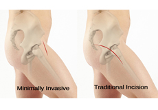 Minimally Invasive Total Hip Replacement