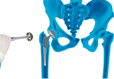 Robotic-Assisted Hip Replacement
