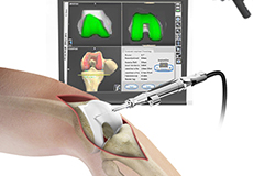 Computer Navigation for Total Knee Replacement