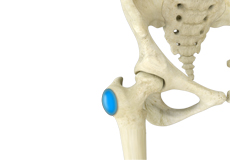 Hip Bursitis