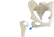 Hip Dislocation