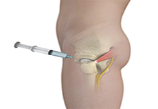 Hip Injections