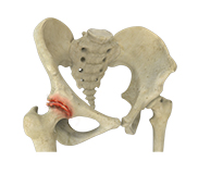 Osteoarthritis of the Hip