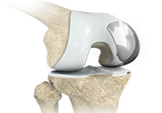 Partial Knee Replacement