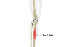 Shin Splints